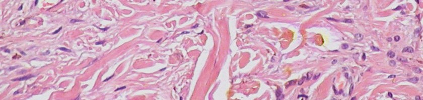 Normal_Epidermis_and_Dermis_with_Intradermal_Nevus_Wikimedia Commons