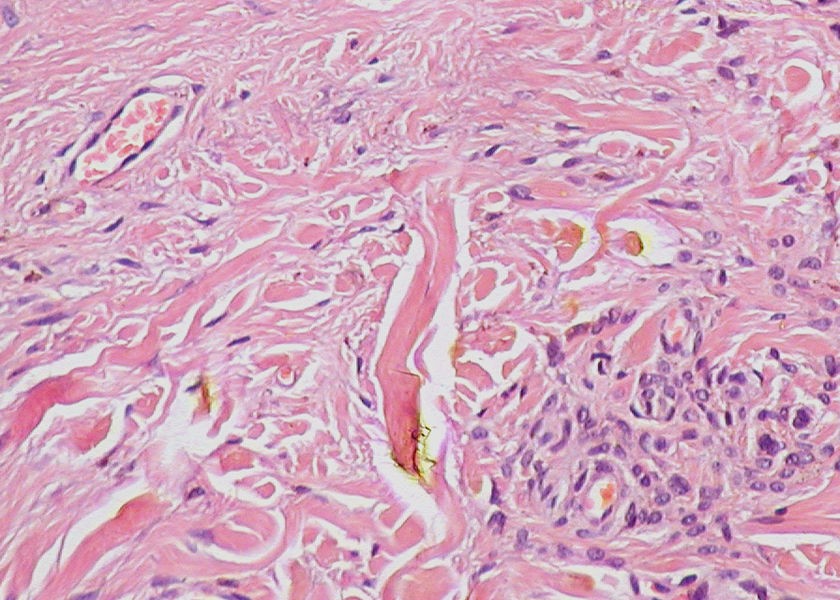 Normal_Epidermis_and_Dermis_with_Intradermal_Nevus_Wikimedia_Commons